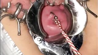 Extreme Cervix Sounding