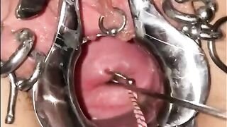 Extreme Cervix Sounding