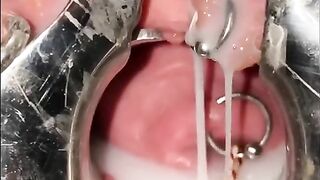 Extreme Cervix Sounding