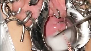 Extreme Cervix Sounding